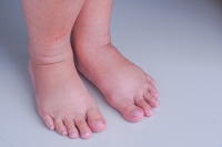 Unusual Causes of Swollen Ankles
