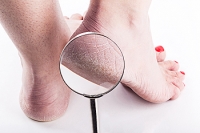 Why Dry Skin Can Lead To Cracked Heals