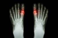 Facts About Gout