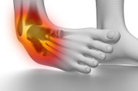 Managing an Ankle Sprain