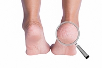 Prompt Treatment Needed for Cracked Heels