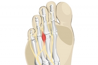 Understanding Morton’s Neuroma and Its Causes