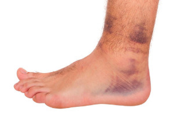 sprain vagy artritisz a láb ízületeinek porcának gyulladása