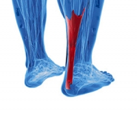 What Is an Achilles Tendon Rupture?