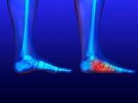 Definition and Causes of Flat Feet