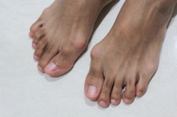 Common Symptoms of Bunions