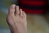 Explanation of Hammertoe