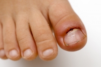 Treating an Abscess on the Toe